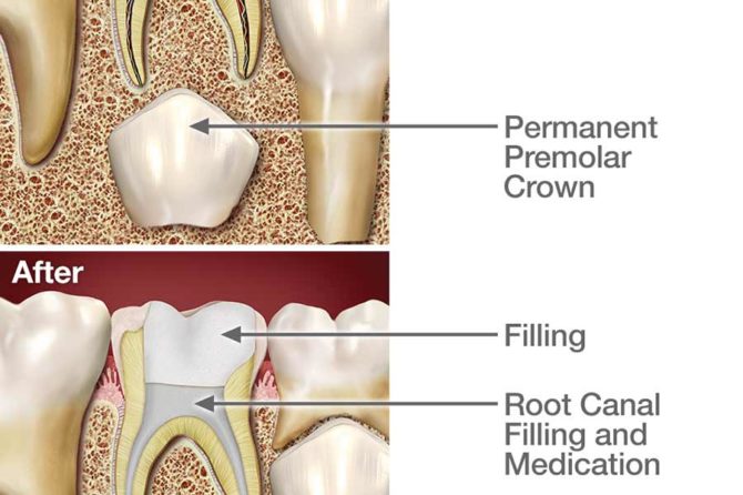 Sometimes children need root canal.