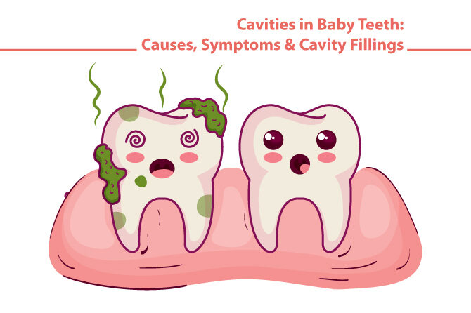 Cavities in Baby Teeth: Causes, Symptoms & Cavity Fillings
