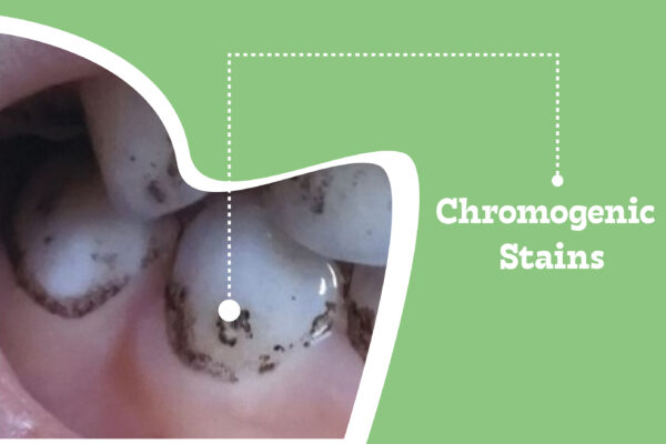 Chromogenic Stains On Children’s Teeth