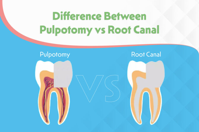 What is the Difference Between Pulpotomy vs Root Canal