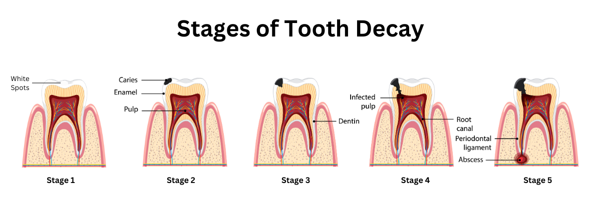 Five Stages of Tooth Decay