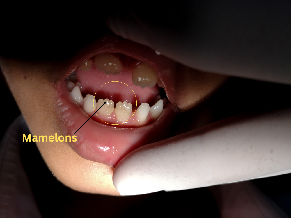 Mamelons On baby Teeth