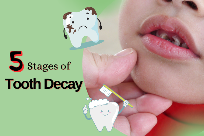 What Are the Five Stages of Tooth Decay?