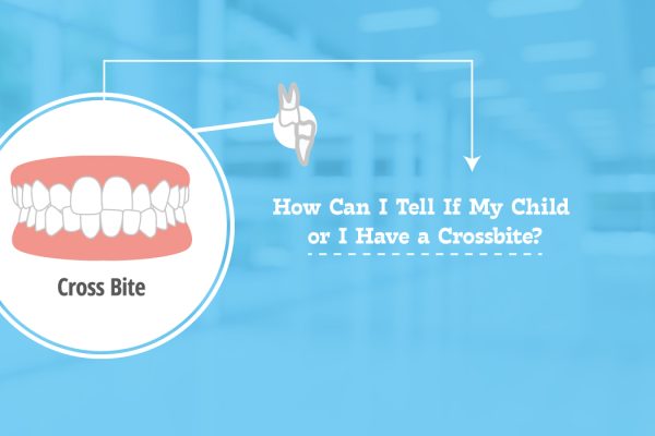 How Can I Tell If My Child or I Have a Crossbite?