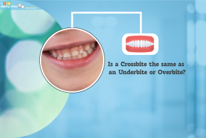 Is a Crossbite the same as an Underbite or Overbite