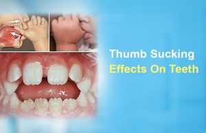 thumb sucking effects on teeth