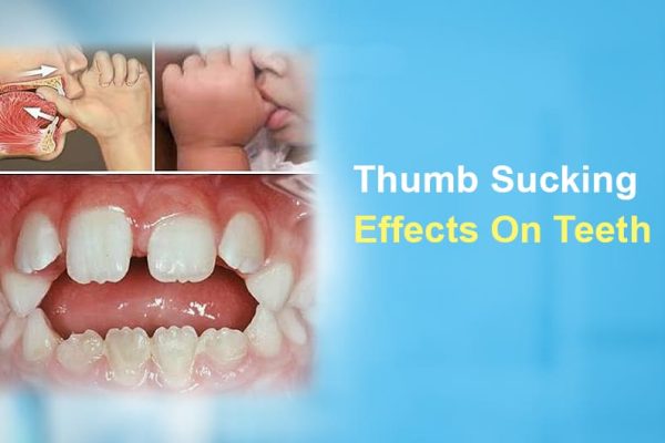 Thumb Sucking Effects on Teeth: How the Habit Can Affect Your Child’s Smile
